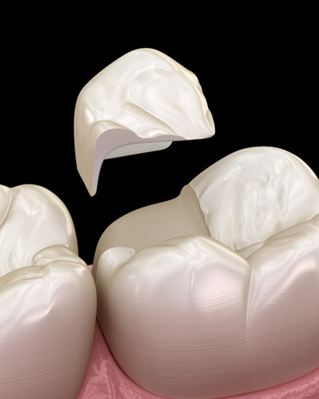 E-Max Esthetic Inlay and Onlay